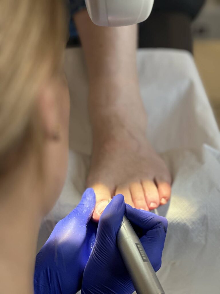 Frezowanie paznokci Koszalin PodologicaMED