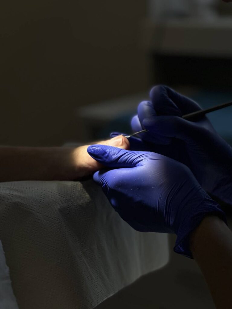 Leczenie zmienionych paznokci Koszalin PodologicaMED