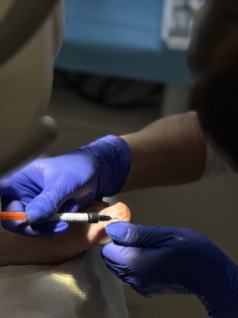 leczenie paznokci Koszalin PodologicaMED