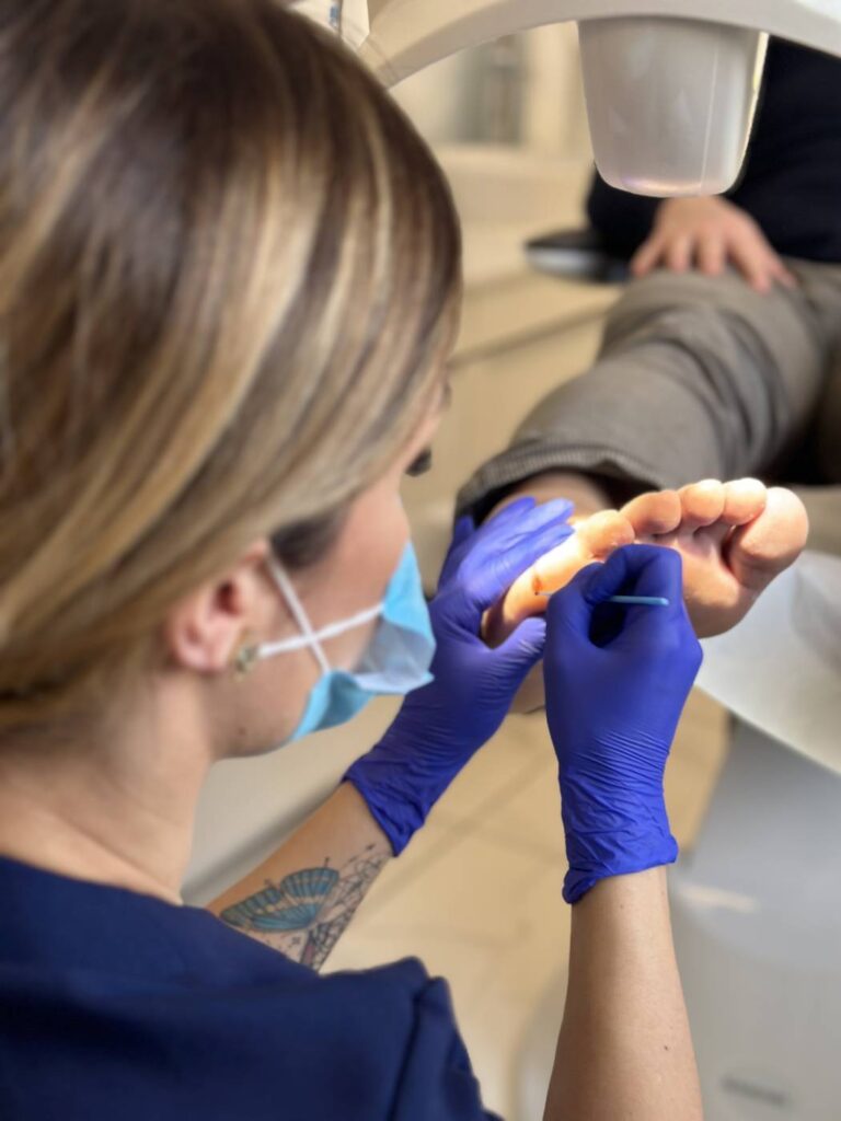 USuwanie odcisków i modzeli Koszalin PodologicaMED