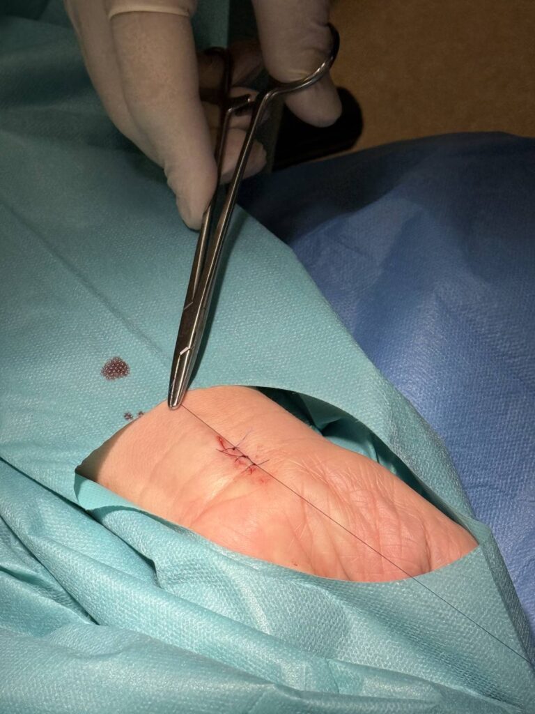 Leczenie trudnych ran Koszalin PodologicaMED