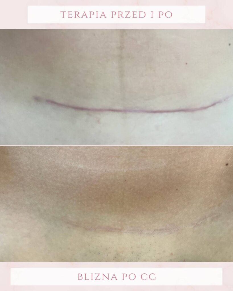Leczenie blizn po CC PodologicaMED Koszalin