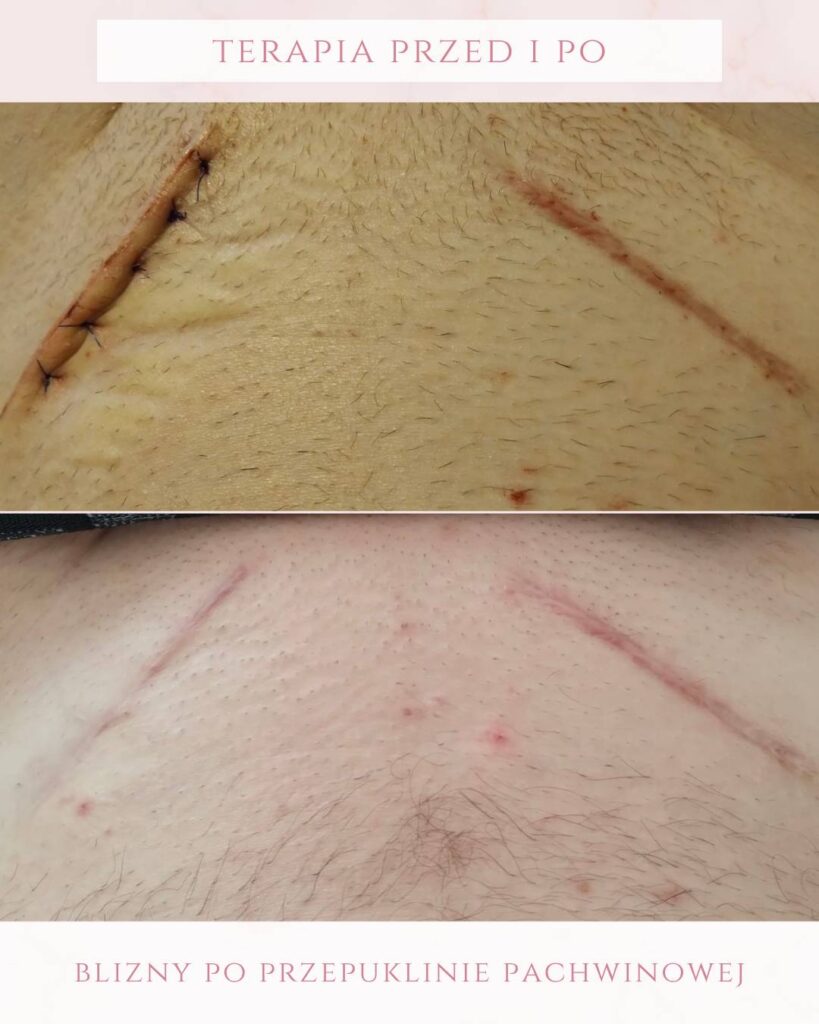 leczenie blizn po przepuklinie Koszalin PodologicaMED