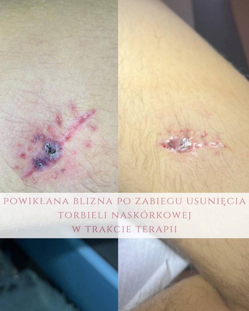 leczenie blizn po torbieli Koszalin PodologicaMED
