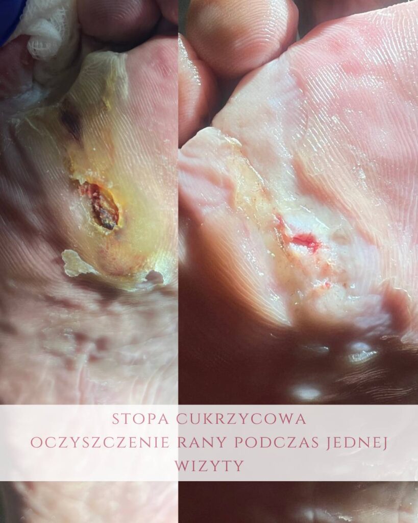 oczyszczanie ran stopy cukrzycowej Koszalin PodologicaMED