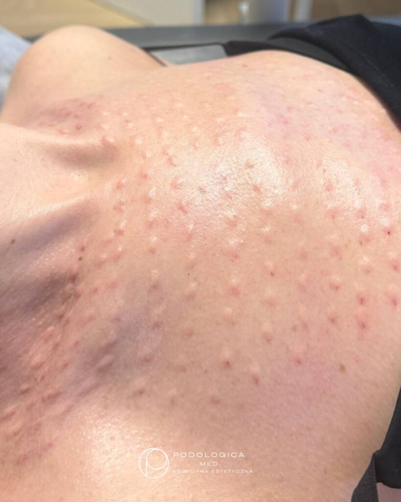 mezoterapia igłowa Koszalin PodologicaMED