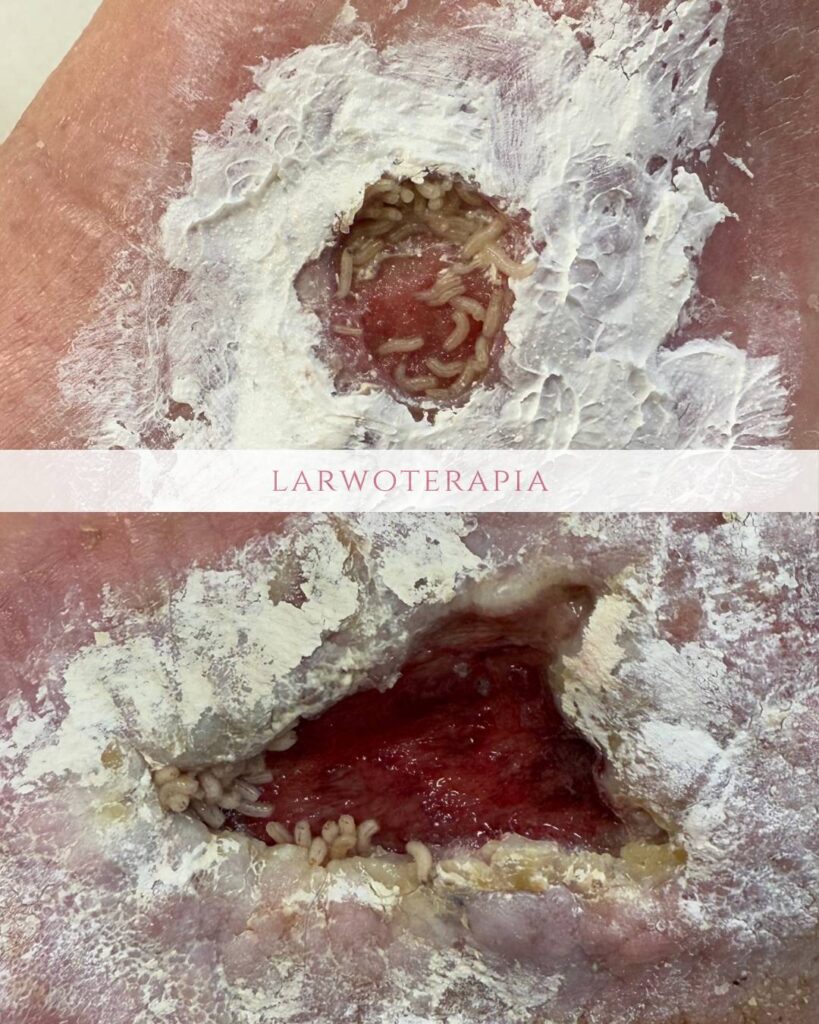 larwoterapia ran Koszalin PodologicaMED