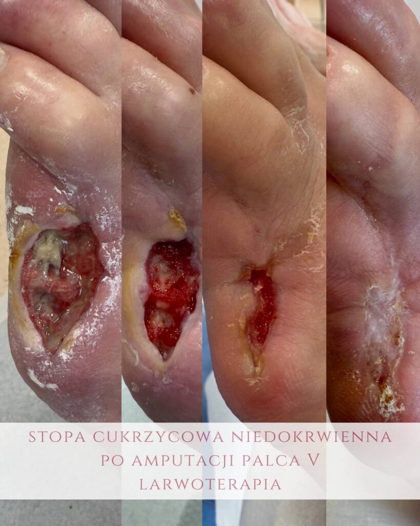 leczenie stopy cukrzycowej niedokrwiennej Koszalin PodologicaMED