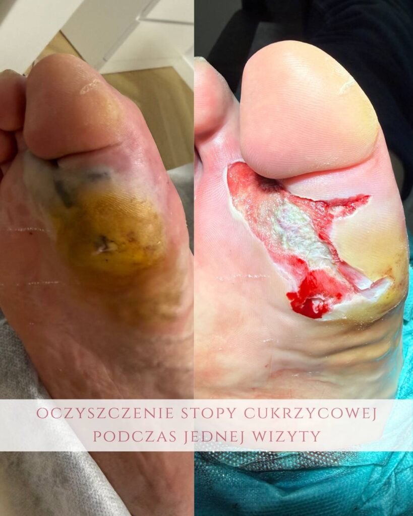 oczyszczanie ran stopy cukrzycowej Koszalin PodologicaMED