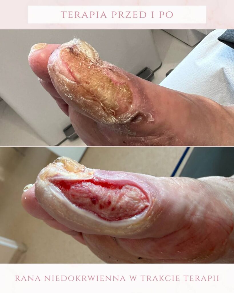 leczenie ran niedokrwiennych Koszalin PodologicaMED