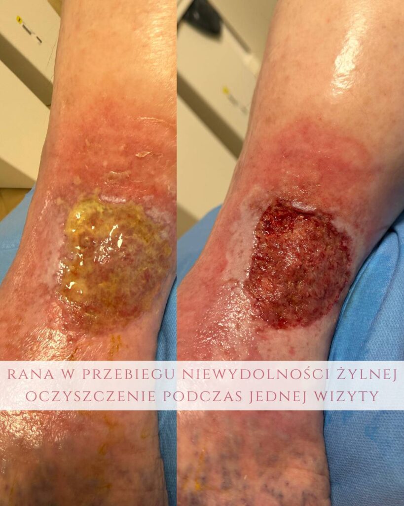 leczenie ran przy niewydolności żylnej Koszalin PodologicaMED
