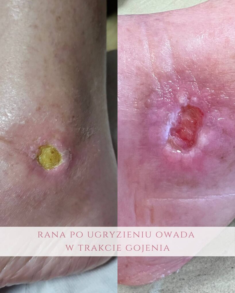 leczeni ran po ugryzieniu owada Koszalin PodologicaMED