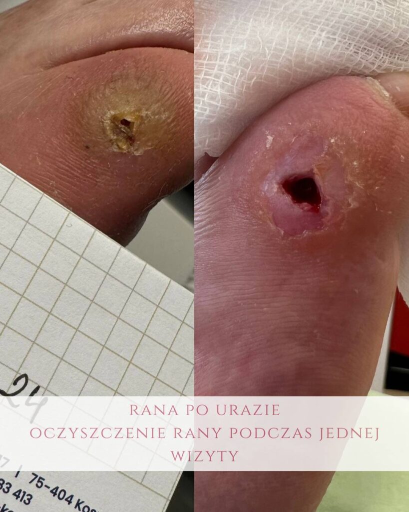 leczenie ran po urazie Koszalin PodologicaMED