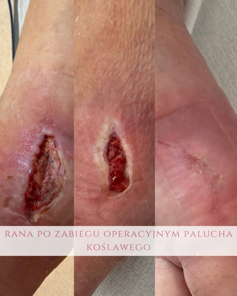 leczenie ran pourazowych Koszalin PodologicaMED