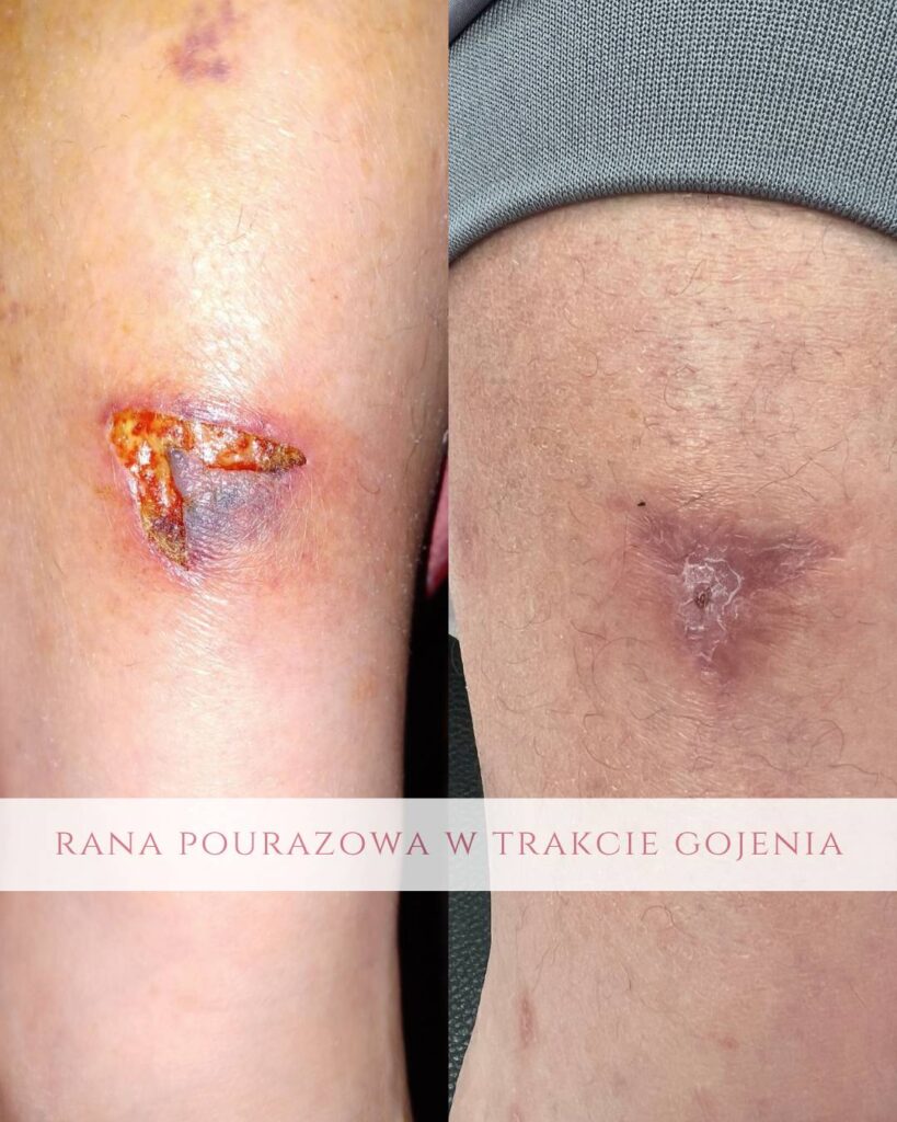 leczenie ran pourazowych Koszalin PodologicaMED
