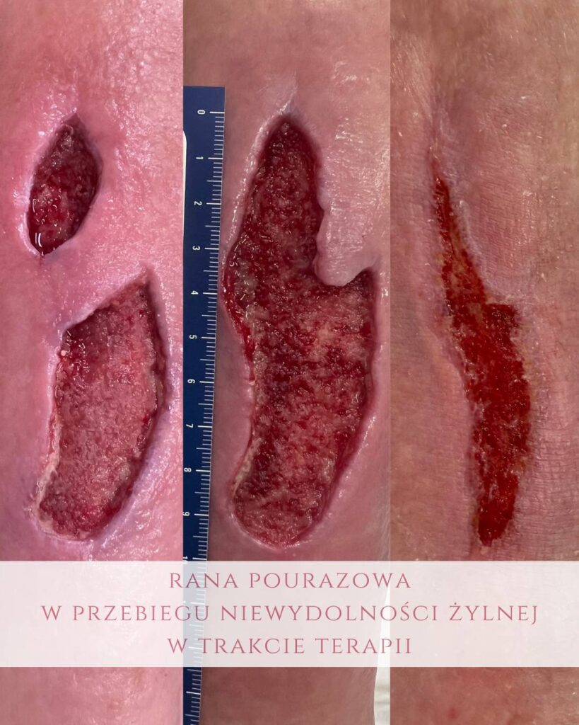 leczenie ran pourazowych z niewydolnością żylną Koszalin PodologicaMED