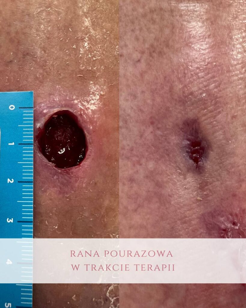 Leczenie ran pourazowych PodologicaMED Koszalin