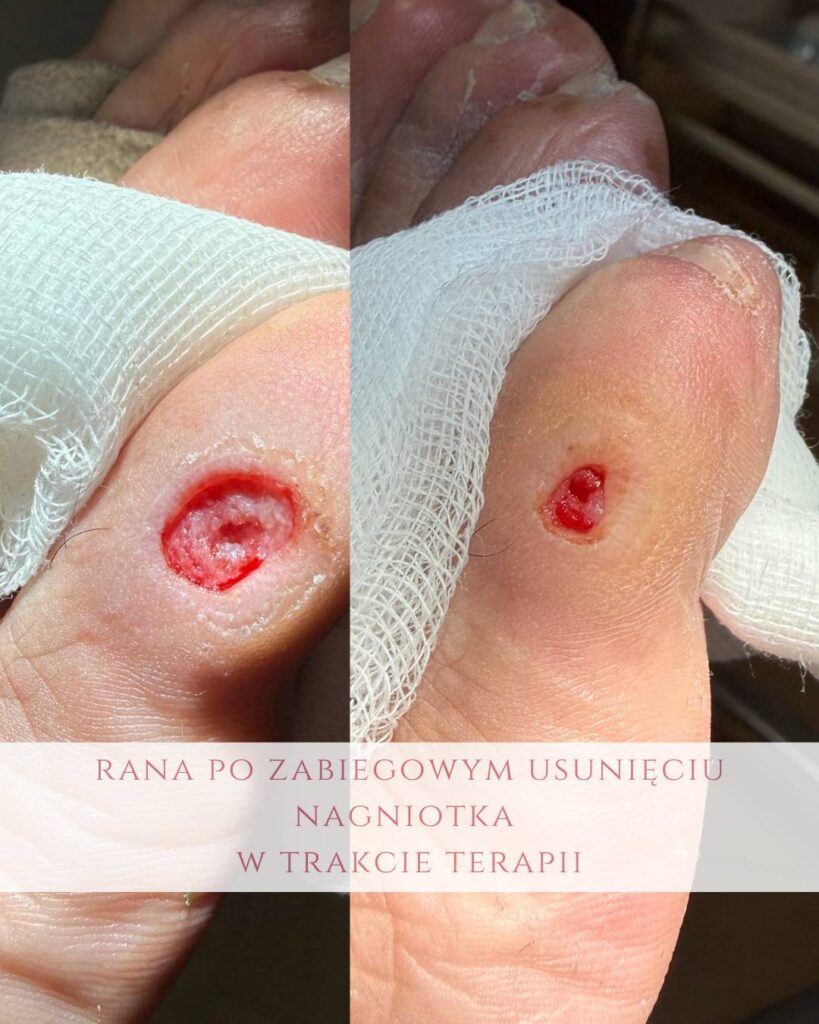 leczenie ran po nagniotku Koszalin PodologicaMED