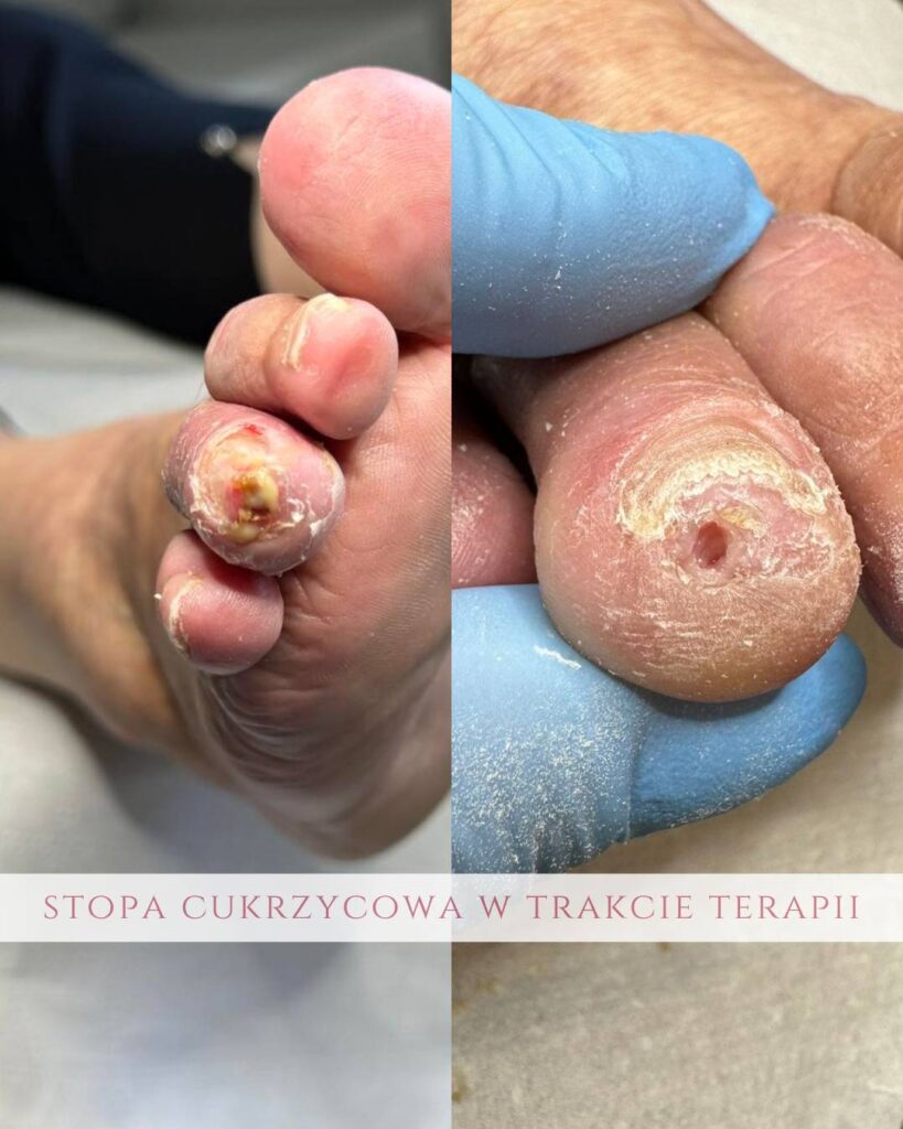 leczenie stopy cukrzycowej Koszalin PodologicaMED