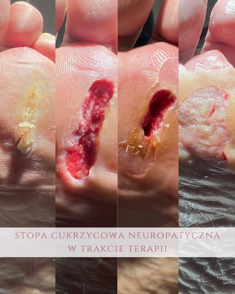 leczenie ran stopy cukrzycowej neuropatycznej Koszalin PodologicaMED