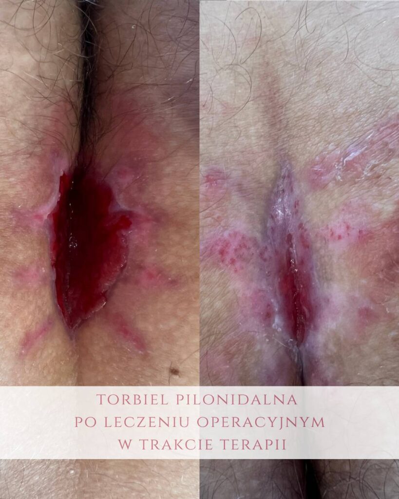 leczenie torbieli pilonidalnych Koszalin PodologicaMED