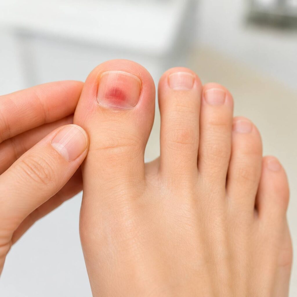 ból pod paznokciem u stopy Koszalin PodologicaMED