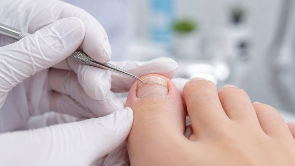zakładanie klamry ortonyksyjnej PodologicaMED
